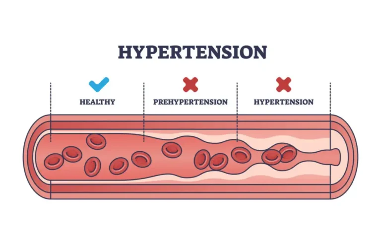 treating hypertension