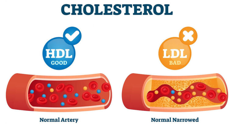 High LDL Raises Risk For A Cardiac Event