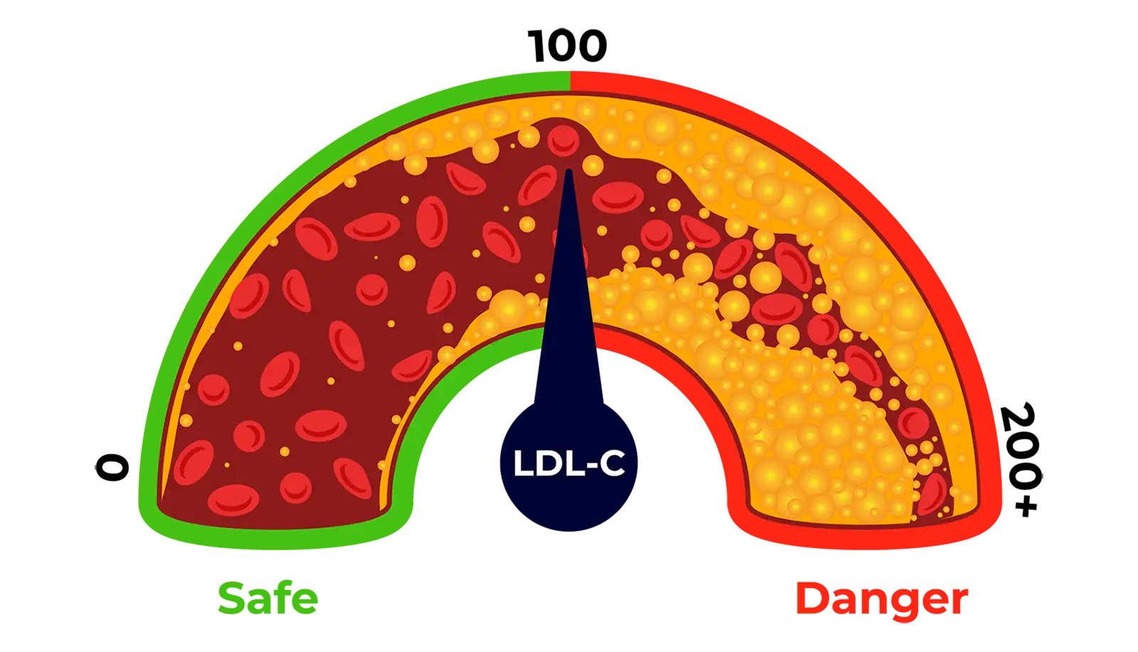 Having High LDL Raises Risk For A Cardiac Event