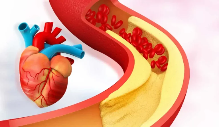 can cholesterol cause heart disease