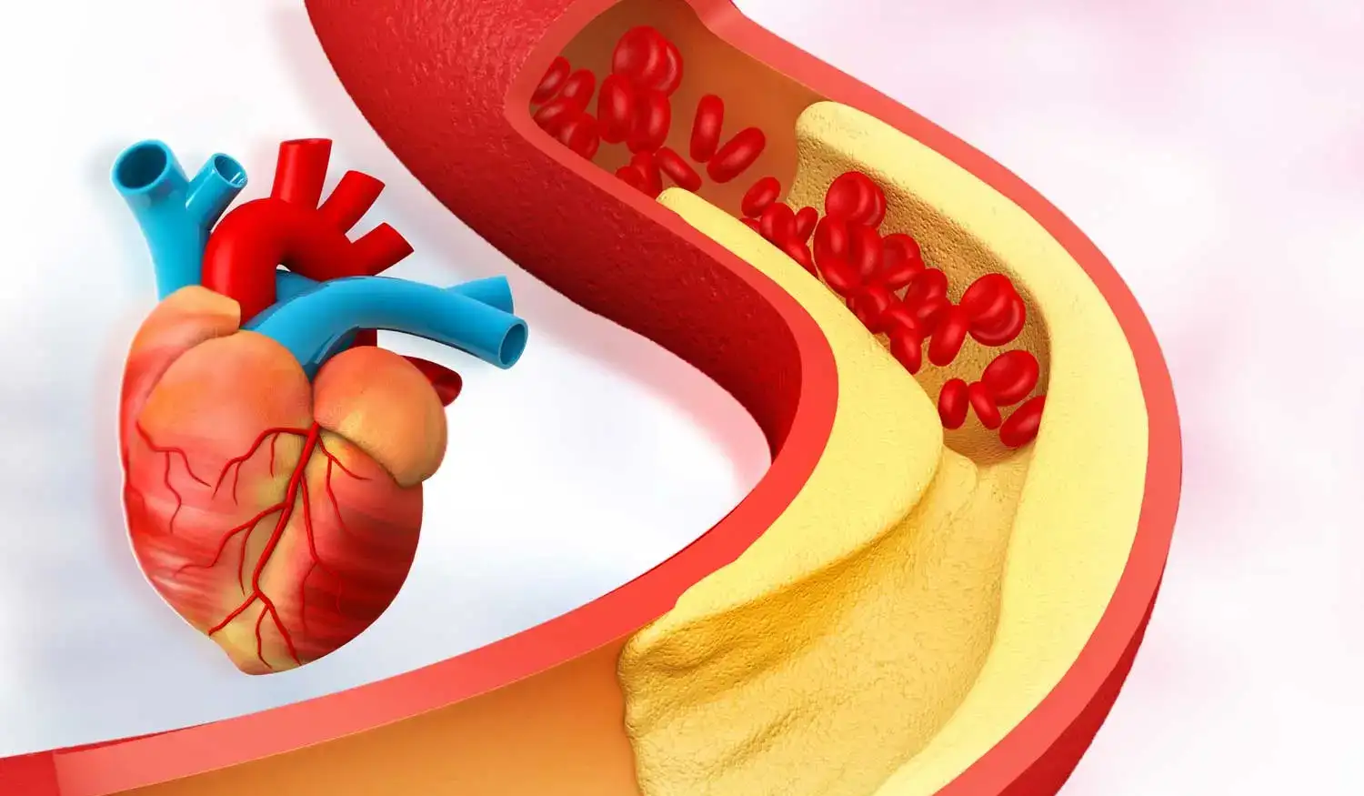 Does Cholesterol Really Cause Heart Disease?