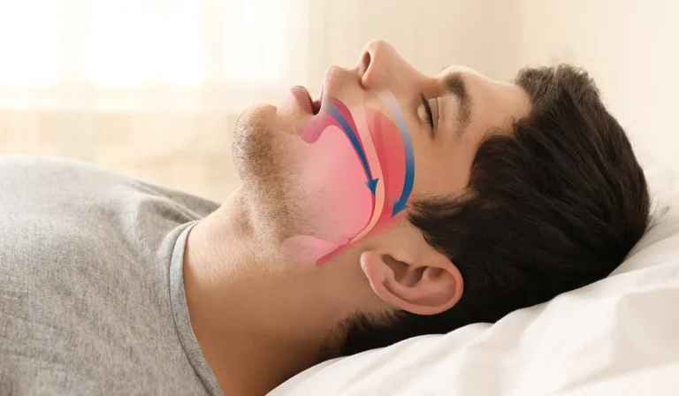 What is Obstructive Sleep Apnea?