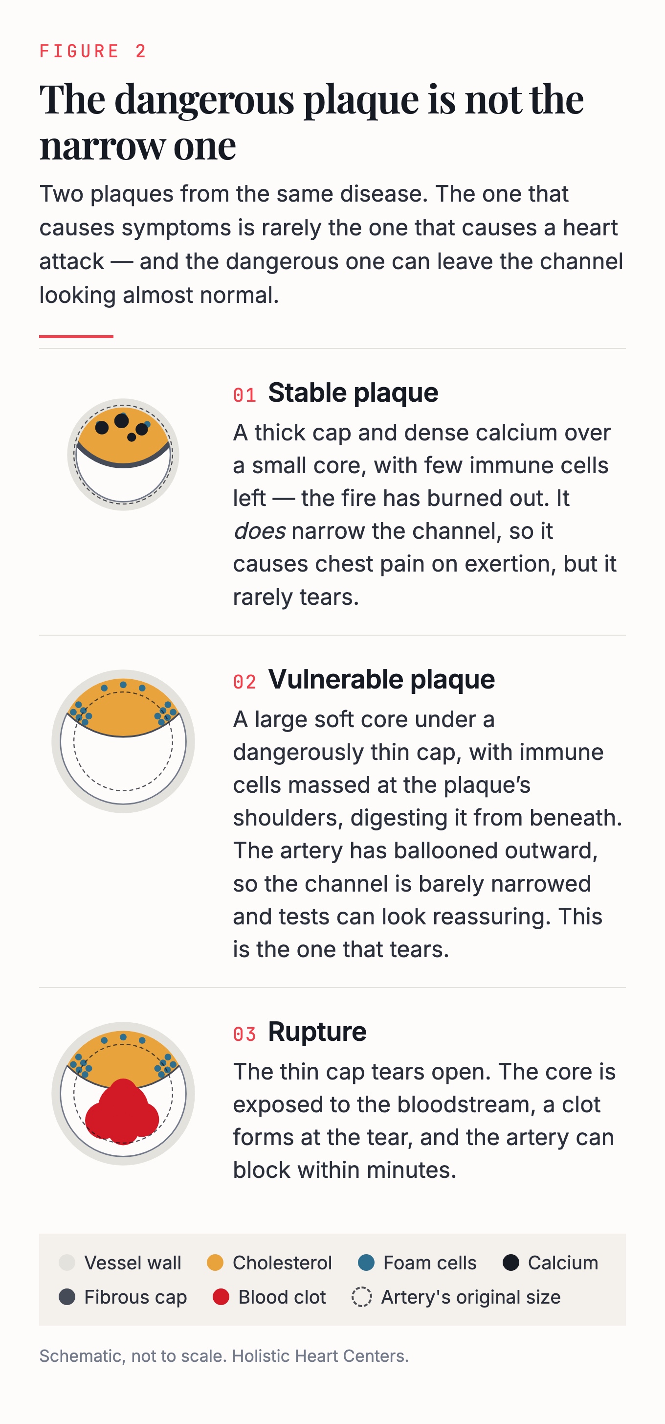 Three cross-sections contrasting a stable plaque with a thick fibrous cap and dense calcium that narrows the channel; a vulnerable plaque with a large soft core under a thin cap in an artery that has enlarged so the channel looks nearly normal; and that same plaque after rupture, with a blood clot forming at the tear.